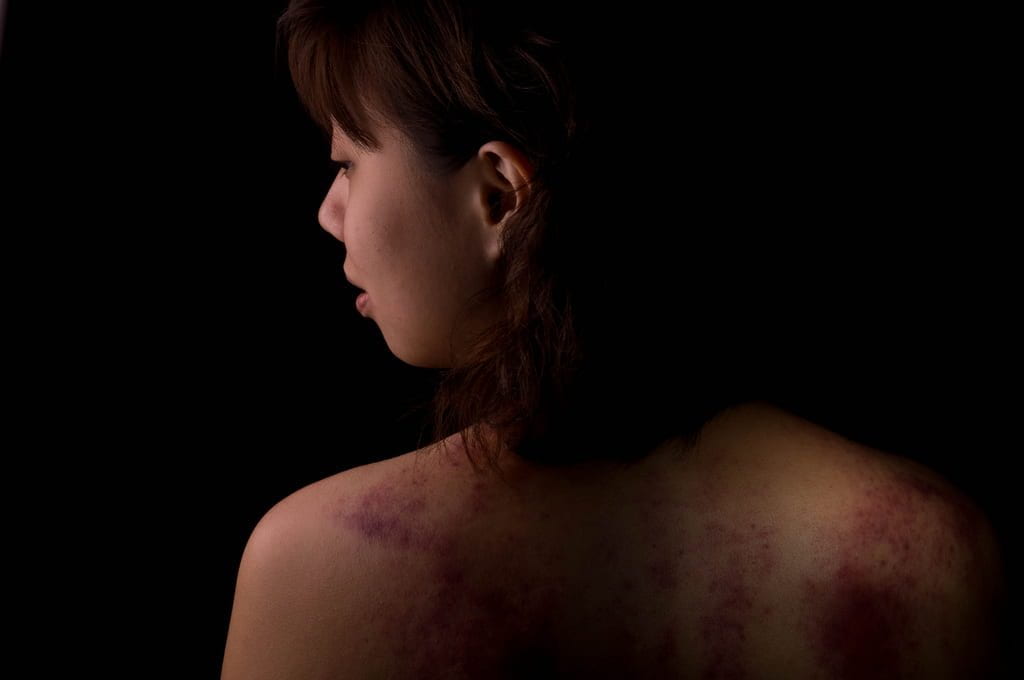 a picture of a girl with bruises on her back